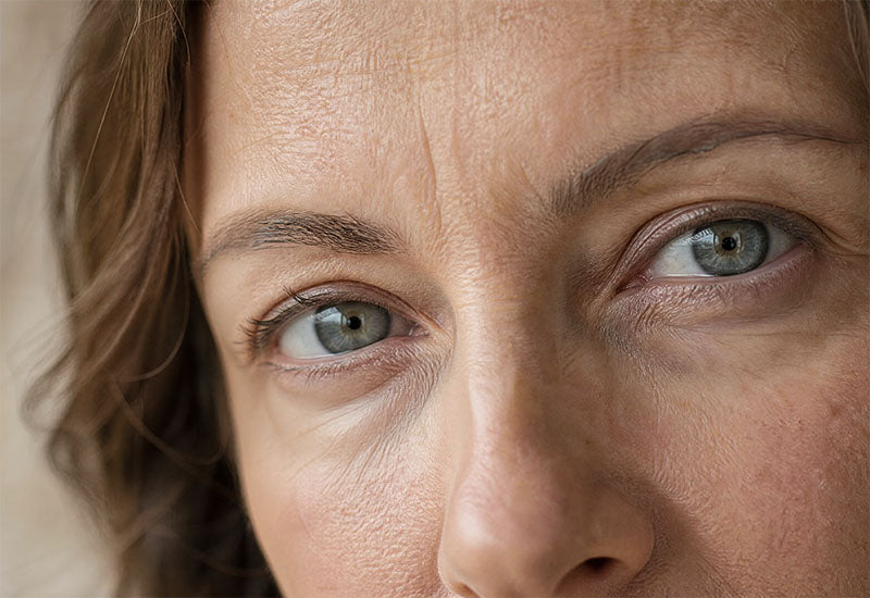 DARK CIRCLES HAVE FOUR DIFFERENT CAUSES.