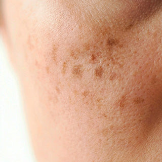 Pigmentation & Dark Spots