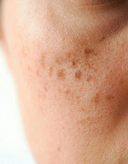 Pigmentation & Dark Spots